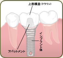 インプラントの構造