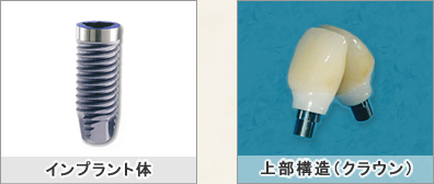 インプラント体と上部構造(クラウン)
